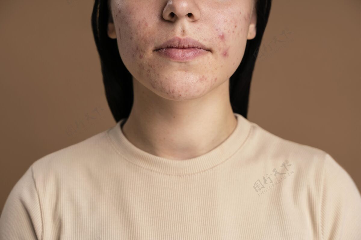 面部自信的年轻女性粉刺特写护理痤疮肖像